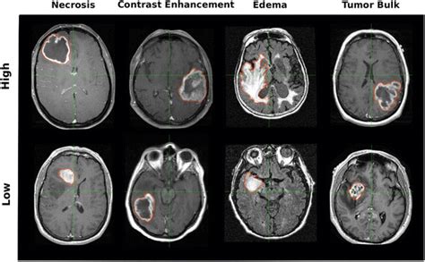 Examples Of Volumetric Tumor Phenotype Features Glioblastoma Gbm