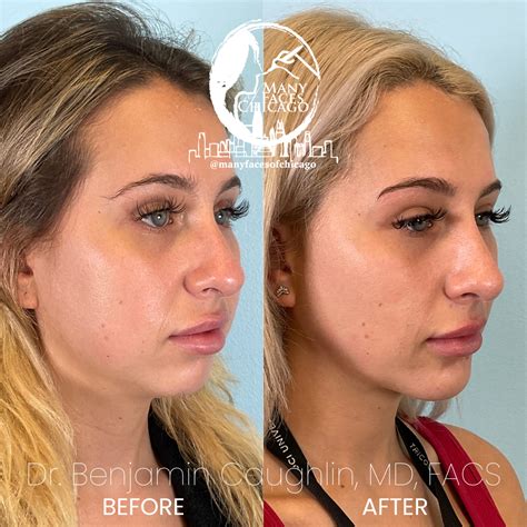 Combination Of Buccal Fat Removal Jawline Sculpting Chin Implant