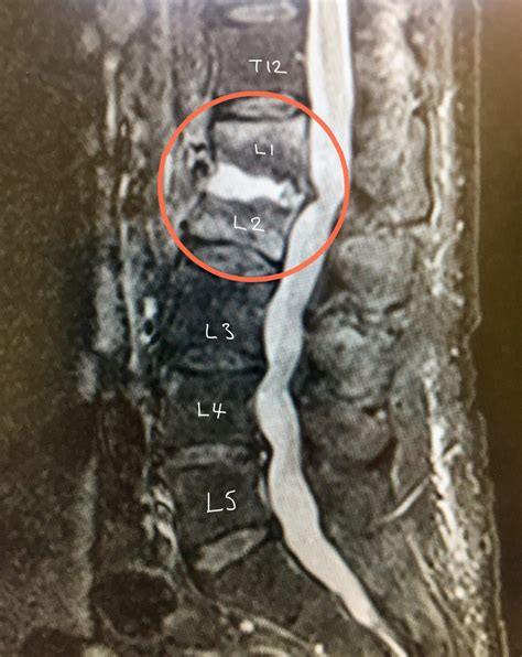 Infections In The Spine Spines Dorset