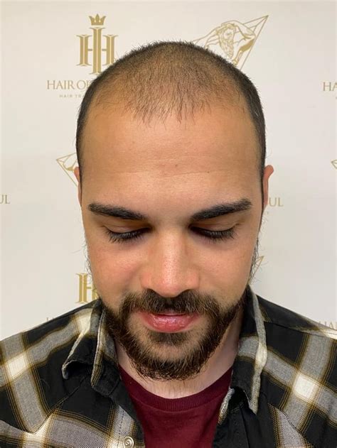 My FUE Hair Transplant Results - 1 Year Hair Transplant Progress : r/hairtransplanters