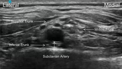 Supraclavicular Nerve Block Ultrasound