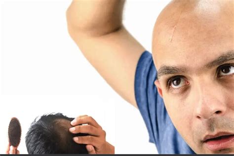 Acupuncture For Hair Loss Treatment Dr Raj Taskar Acupuncture Clinic