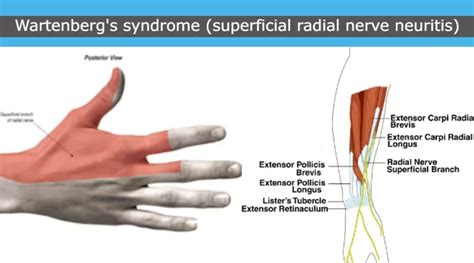 Wartenbergs Syndrome Treatment Archives Samarpan Physiotherapy