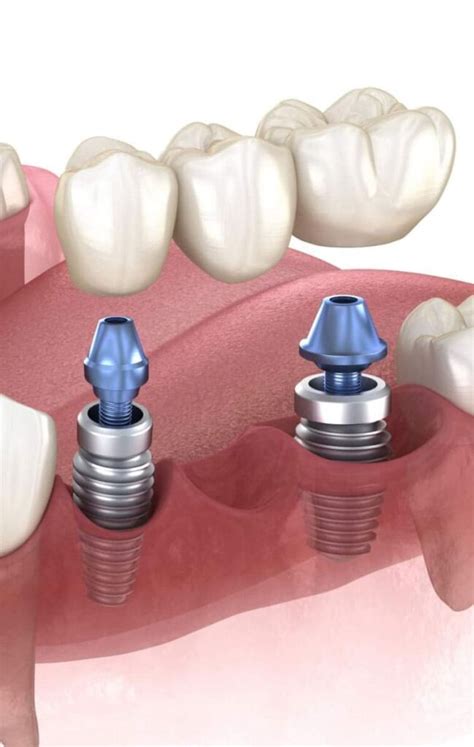 Same Day Implants Dentetik Dental Clinic In Istanbul Turkey