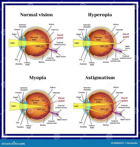 Refractive Errors Eyeball: Hyperopia, Myopia, Astigmatism. Vector ...