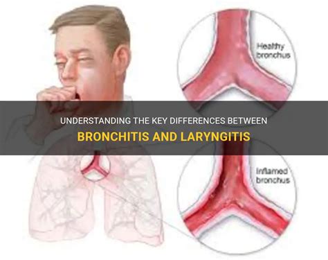 Understanding The Key Differences Between Bronchitis And Laryngitis