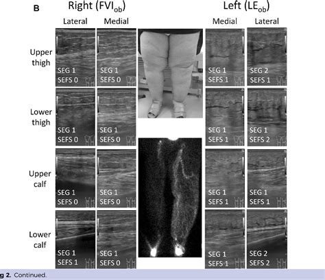 Figure 1 From Differentiation Of Functional Venous Insufficiency And Leg Lymphedema Complicated