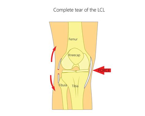 Lateral Collateral Ligament Knee Injury