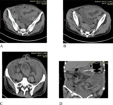 A B C D Ct Scan Of The Abdomen Showing The Intussusception In