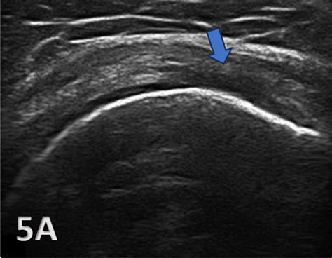 Utilizing Diagnostic Musculoskeletal Ultrasound for Assessment of the Infraspinatus Muscle and ...