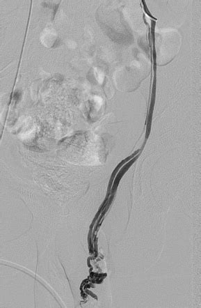 Varicocele Embolization Through Neck