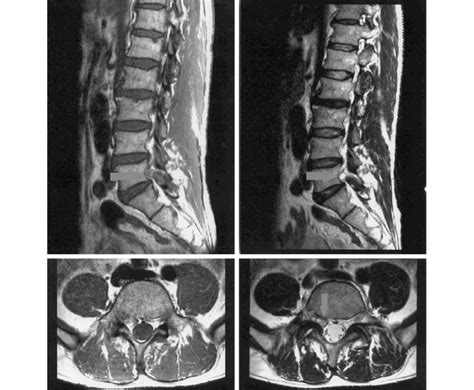 T1-weighted and T2-weighted MRI image shows 0.8 cm sized cystic mass ...