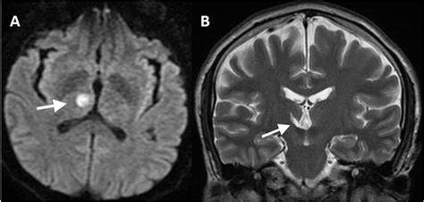 Complete Recovery Of Restless Legs Syndrome After Unilateral Thalamic