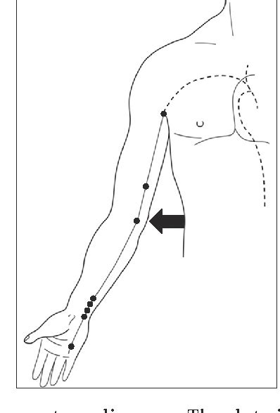 Figure 3 From Severe Ulnar Nerve Injury After Bee Venom Acupuncture At