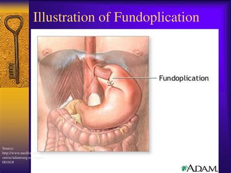 Ppt Medical Nutrition Therapy For Upper Gastrointestinal Tract