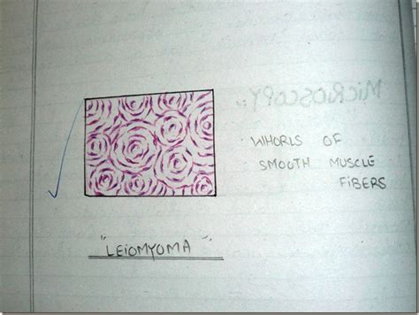 Histology Slides Database: leiomyoma histopathology diagram online