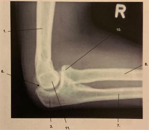 roentgen ellbogen lateral flashcards quizlet