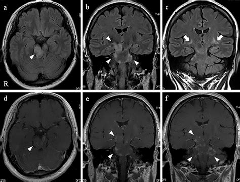 Figure Brain Magnetic Resonance Image Mri On The First Admission