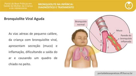 Bronquiolite Na Inf Ncia Diagn Stico E Tratamento Ppt