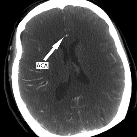 Imaging Of Stroke Part Perfusion Ct Overview Of Imaging Technique