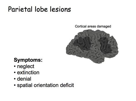 Parietal Lobe Stroke Signs Symptoms And Complications 48 Off