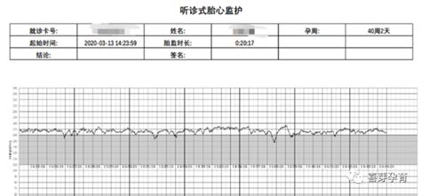 高能干货——如何读懂胎心监护曲线？ 知乎