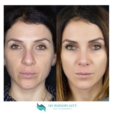 Naso A Patata La Chirurgia Per Correggerlo My Rhinoplasty