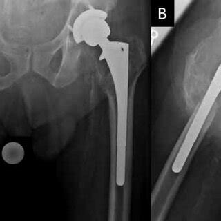 One Year Postoperative Anteroposterior Pelvis Radiograph Fig A And