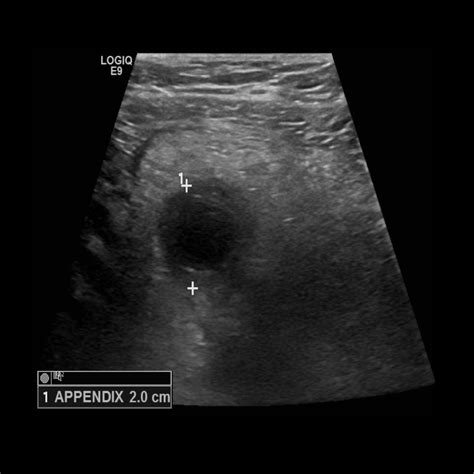 Appendix Measurement Ultrasound