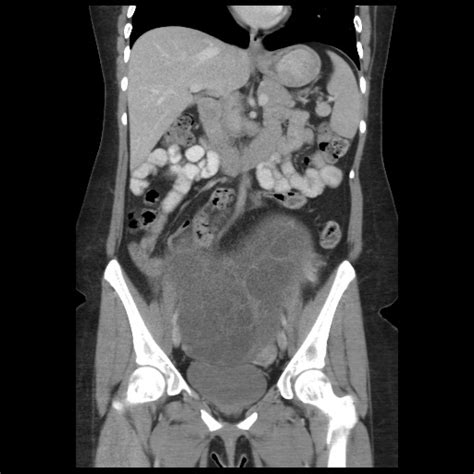 Borderline Mucinous Tumor Ovary Image Radiopaedia Org