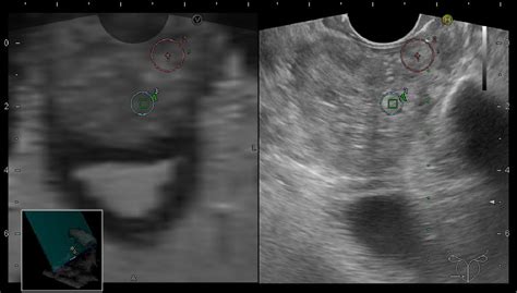 Figure 1 From Role Of Targeted MRI US Fusion Guided Biopsies For