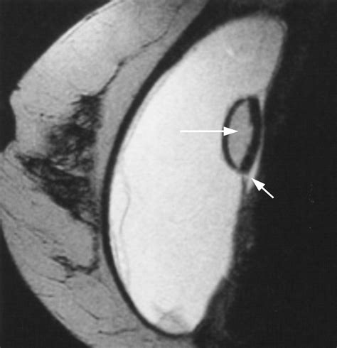 Breast Implant Classification With Mr Imaging Correlation Radiographics