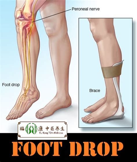 Understanding Foot Drop Ask The Nurse Expert