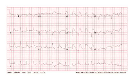 Acute Pulmonary Embolism Presenting With Stemi Like Ecg Changes