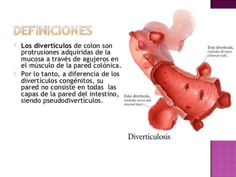 Enfermedad Diverticular 2012 Clinica San Pablo