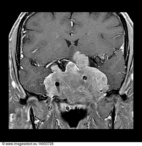 Invasive Pituitary Adenoma on MRI Invasive Pituitary Adenoma on MRI ...