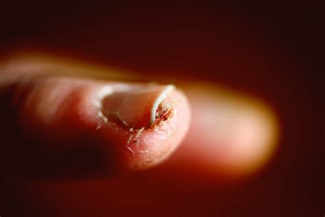 How To Fix An Ingrown Fingernail Treatment Prevention Diy