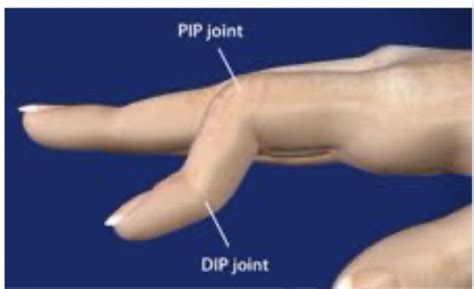 Internal Medicine Ortho Rheumatology Flashcards Quizlet