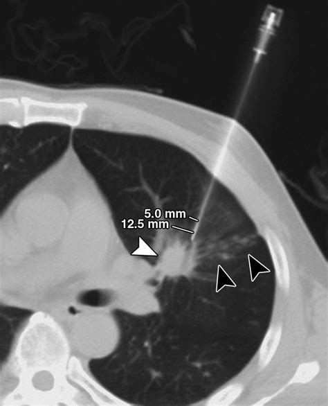 Ct Guided Core Biopsy Of Lung Lesions A Primer Ajr