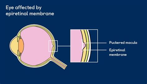 What Is Epiretinal Membrane Dr Vaidya Eye Hospital Medium