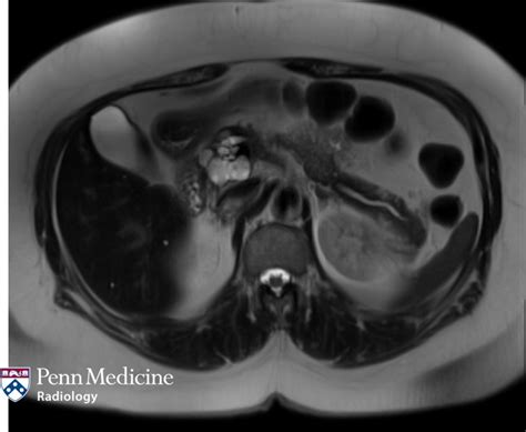 66 Year Old Woman With Incidental Pancreatic Mass Auntminnie