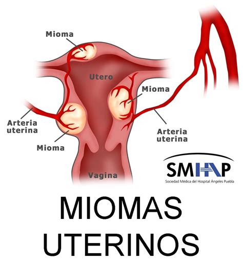 Miomas uterinos Sociedad Médica del Hospital Ángeles Puebla