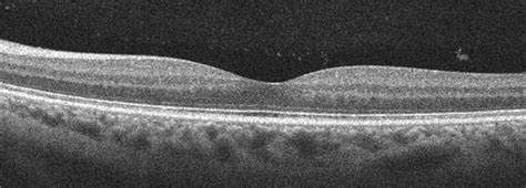 Optische Koh Renztomographie Oct Augenarzt Privatpraxis Hamburg