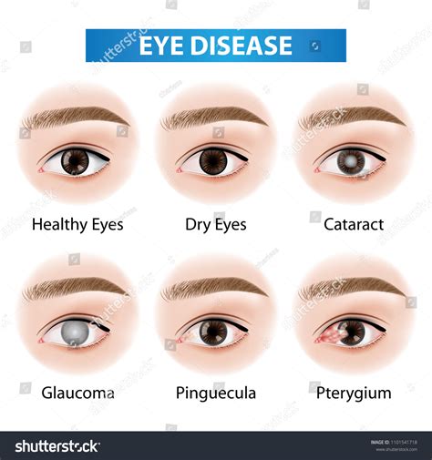 20,407 Eye disease Stock Vectors, Images & Vector Art | Shutterstock