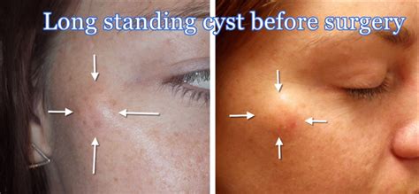 Sebaceous Cyst Removal Scar