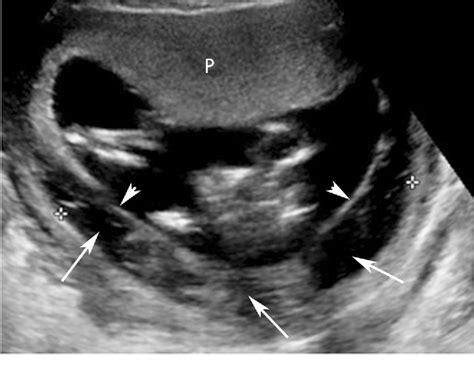 Placental Abruption And Hemorrhage—review Of Imaging Appearance