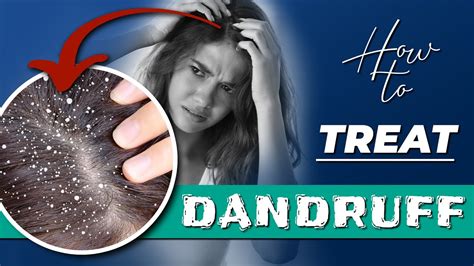 How To Get Rid Of Dandruff Quick And Easy Treatments Youtube