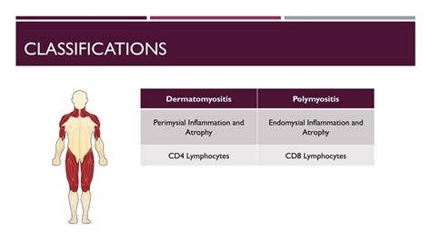 Ppt Dermatomyositis And Polymyositis Powerpoint Presentation Free