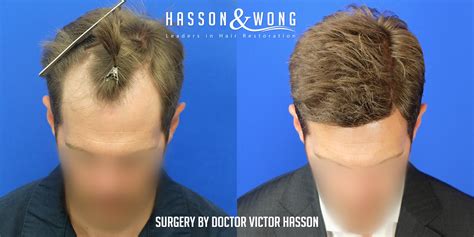 Hair Transplant Before After Some Of Our Favorite Results From 2019