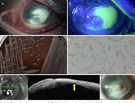 Figure 2 From Polymicrobial Keratitis Of Pseudomonas Aeruginosa Acinetobacter Baumannii And